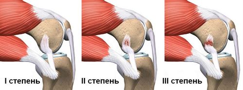 Степени повреждения связок коленного сустава