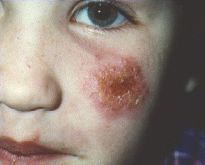 Фото воспалений у детей