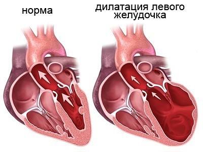 Аритмогенная кардиомиопатия правого желудочка