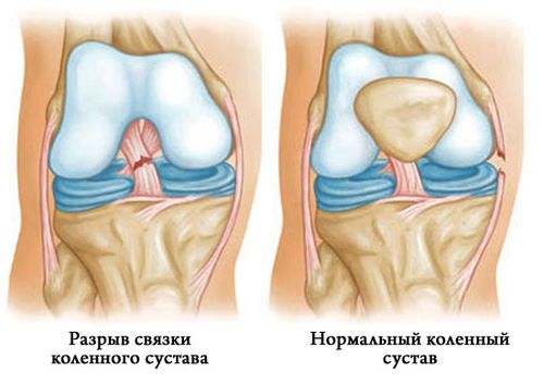 Классификация разрыва связок колена