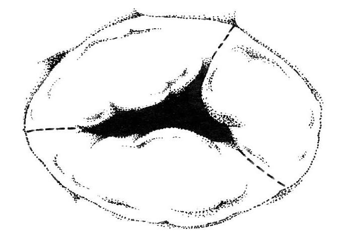 Представление стенотического трикуспидального клапана. Это изображение демонстрирует слияние комиссур (показано пунктирными линиями).