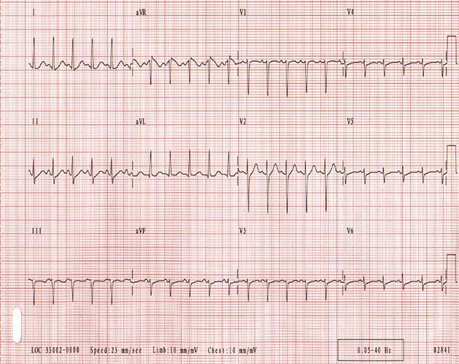 Синусовая тахикардия. Отметим, что комплексы QRS являются узкими и регулярными. Частота сердечных сокращений у пациента составляет приблизительно 135 уд / мин. P-волны являются нормальными в морфологии.