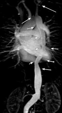 Диффузный стеноз от дуги аорты до брюшной аорты. Левая общая сонная артерия также стенозирована, а левая подключичная артерия не визуализируется.