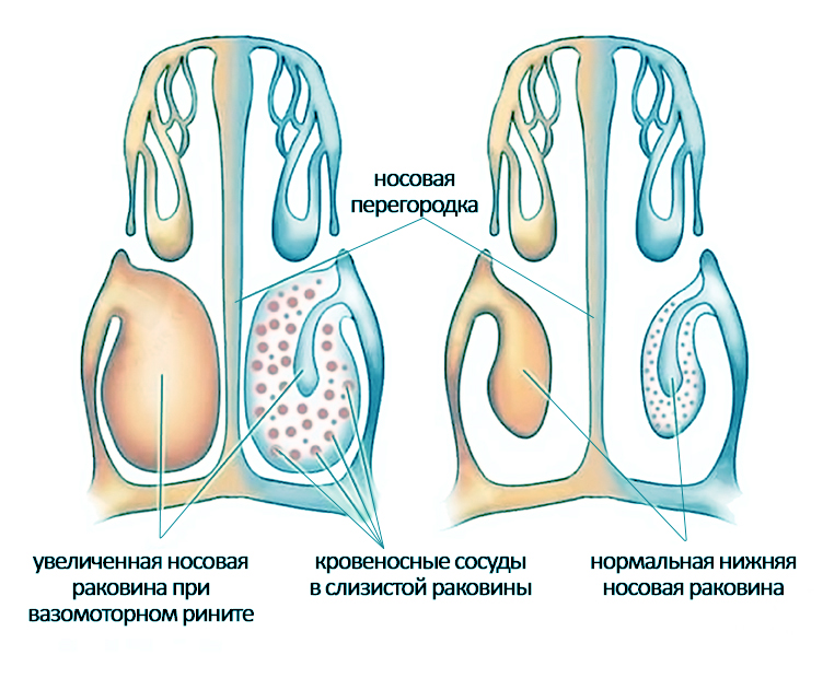 vazomotornyj