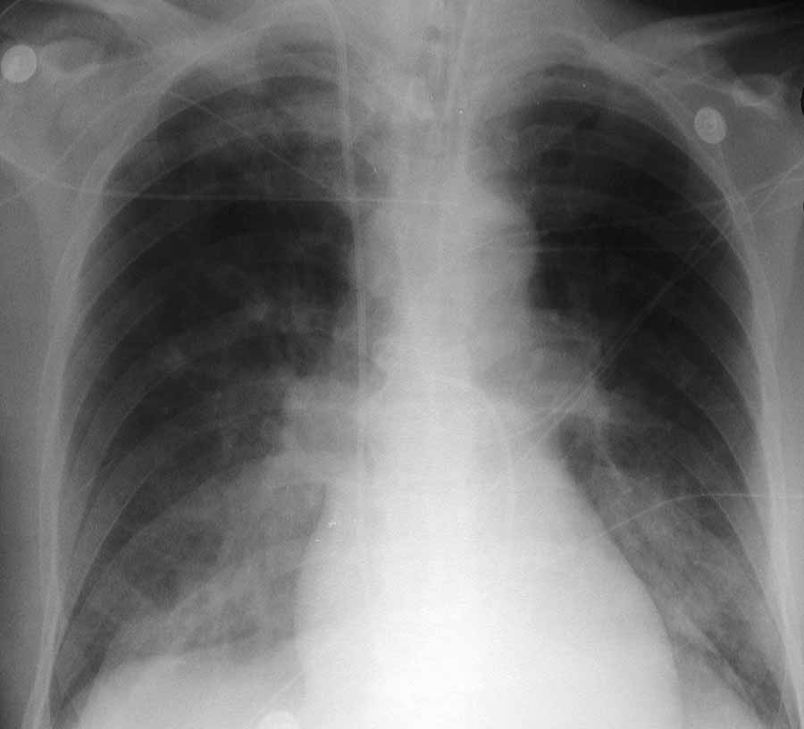 Рентгенограмма показывает острый отек легких у пациента, который поступил с острым передним инфарктом миокарда. 